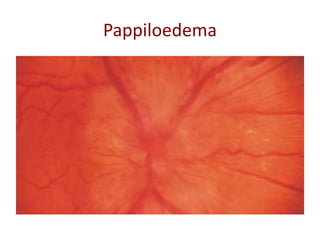 Pappiloedema
 