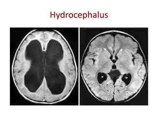 Hydrocephalus
 