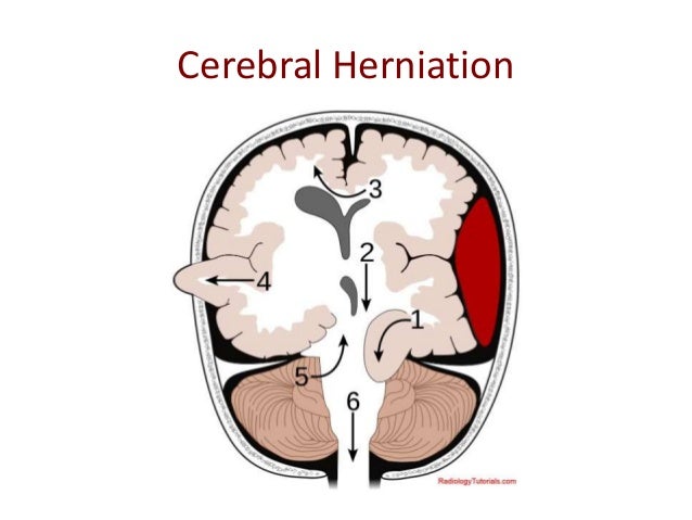 brain herniation