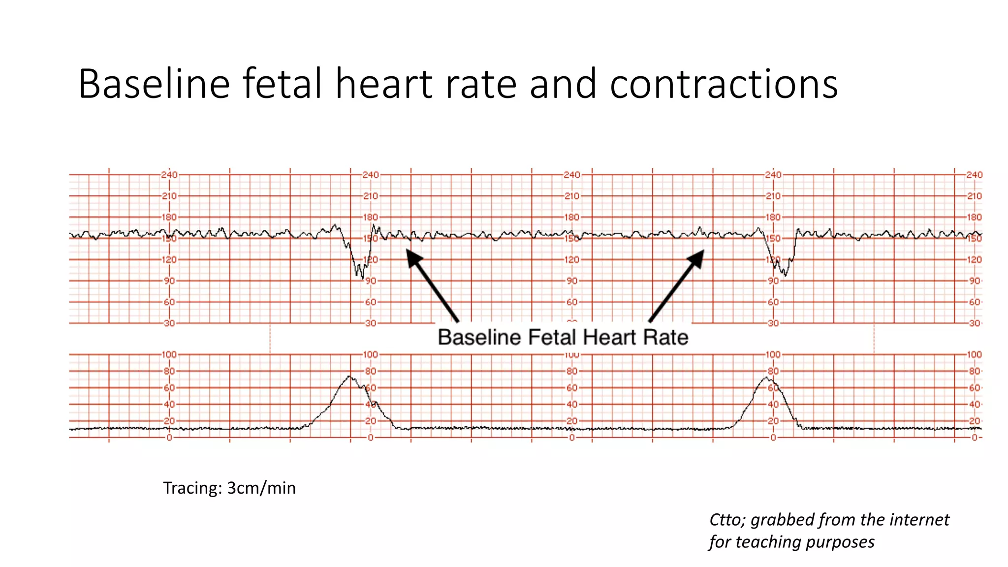 electonic-fetal-monitoring-sgd.pdf