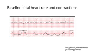 electonic-fetal-monitoring-sgd.pdf