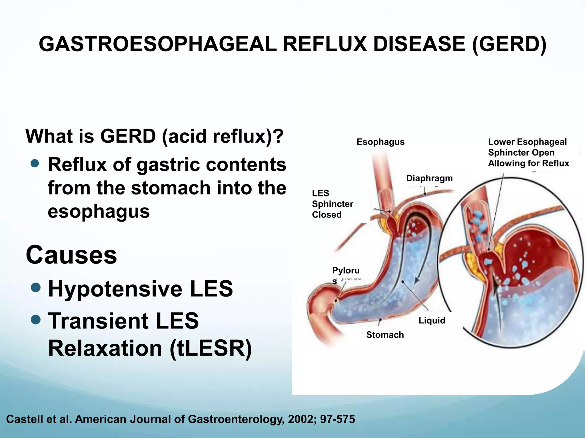 Eletro Stimulation of Lower Esophageal Sphincter on GERD treatment | PPT