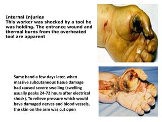 Internal Injuries
This worker was shocked by a tool he
was holding. The entrance wound and
thermal burns from the overheated
tool are apparent




   Same hand a few days later, when
   massive subcutaneous tissue damage
   had caused severe swelling (swelling
   usually peaks 24-72 hours after electrical
   shock). To relieve pressure which would
   have damaged nerves and blood vessels,
   the skin on the arm was cut open
 