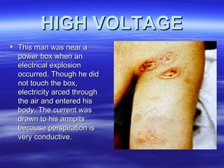 Electrical Injuries | PPT