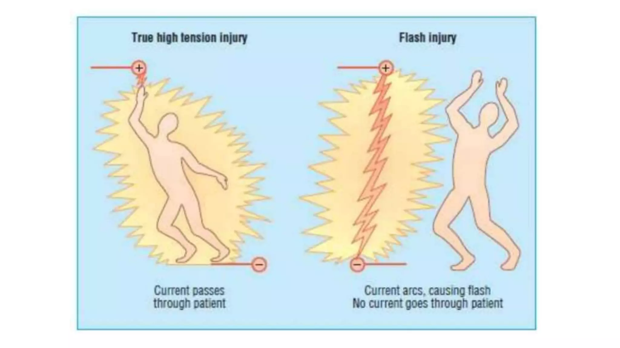 Electric Burn Example Electrical Burn.pptx