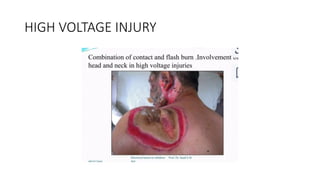 HIGH VOLTAGE INJURY
 