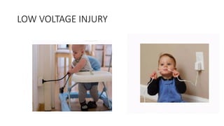 LOW VOLTAGE INJURY
 