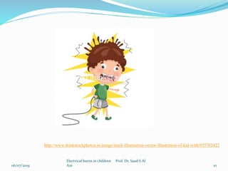 06/07/2019
Electrical burns in children Prof. Dr. Saad S Al
Ani 10
http://www.thinkstockphotos.in/image/stock-illustration-vector-illustration-of-kid-with/935702422
 