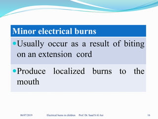 06/07/2019 Electrical burns in children Prof. Dr. Saad S Al Ani 16
Minor electrical burns
Usually occur as a result of biting
on an extension cord
Produce localized burns to the
mouth
 