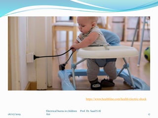 06/07/2019
Electrical burns in children Prof. Dr. Saad S Al
Ani 17
https://www.healthline.com/health/electric-shock
 
