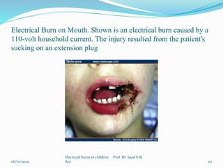 Electrical Burn on Mouth. Shown is an electrical burn caused by a
110-volt household current. The injury resulted from the patient's
sucking on an extension plug
06/07/2019
Electrical burns in children Prof. Dr. Saad S Al
Ani 20
 