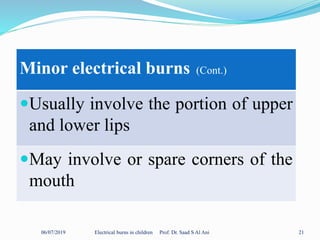 06/07/2019 Electrical burns in children Prof. Dr. Saad S Al Ani 21
Minor electrical burns (Cont.)
Usually involve the portion of upper
and lower lips
May involve or spare corners of the
mouth
 