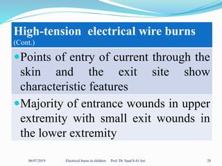 06/07/2019 Electrical burns in children Prof. Dr. Saad S Al Ani 28
High-tension electrical wire burns
(Cont.)
Points of entry of current through the
skin and the exit site show
characteristic features
Majority of entrance wounds in upper
extremity with small exit wounds in
the lower extremity
 
