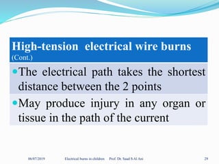 06/07/2019 Electrical burns in children Prof. Dr. Saad S Al Ani 29
High-tension electrical wire burns
(Cont.)
The electrical path takes the shortest
distance between the 2 points
May produce injury in any organ or
tissue in the path of the current
 