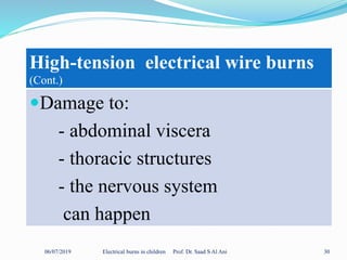 06/07/2019 Electrical burns in children Prof. Dr. Saad S Al Ani 30
High-tension electrical wire burns
(Cont.)
Damage to:
- abdominal viscera
- thoracic structures
- the nervous system
can happen
 