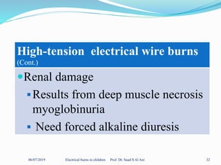 06/07/2019 Electrical burns in children Prof. Dr. Saad S Al Ani 32
High-tension electrical wire burns
(Cont.)
Renal damage
Results from deep muscle necrosis
myoglobinuria
 Need forced alkaline diuresis
 