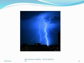 06/07/2019
Electrical burns in children Prof. Dr. Saad S Al
Ani 35
 