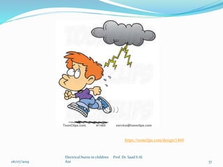 06/07/2019
Electrical burns in children Prof. Dr. Saad S Al
Ani 37
https://toonclips.com/design/1460
 