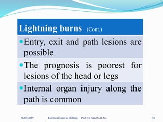06/07/2019 Electrical burns in children Prof. Dr. Saad S Al Ani 38
Lightning burns (Cont.)
Entry, exit and path lesions are
possible
The prognosis is poorest for
lesions of the head or legs
Internal organ injury along the
path is common
 