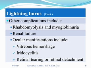 06/07/2019 Electrical burns in children Prof. Dr. Saad S Al Ani 43
Lightning burns (Cont.)
Other complications include:
 Rhabdomyolysis and myoglobinuria
 Renal failure
 Ocular manifestations include:
 Vitreous hemorrhage
 Iridocyclitis
 Retinal tearing or retinal detachment
 