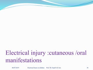 Electrical injury :cutaneous /oral
manifestations
06/07/2019 Electrical burns in children Prof. Dr. Saad S Al Ani 56
 