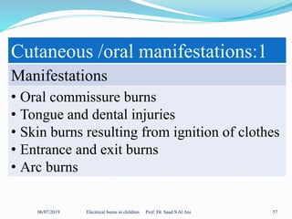 06/07/2019 Electrical burns in children Prof. Dr. Saad S Al Ani 57
Cutaneous /oral manifestations:1
Manifestations
• Oral commissure burns
• Tongue and dental injuries
• Skin burns resulting from ignition of clothes
• Entrance and exit burns
• Arc burns
 