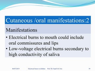 06/07/2019 Electrical burns in children Prof. Dr. Saad S Al Ani 59
Cutaneous /oral manifestations:2
Manifestations
• Electrical burns to mouth could include
oral commissures and lips
• Low-voltage electrical burns secondary to
high conductivity of saliva
 