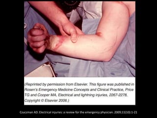 Electrical injury and burn | PPTX
