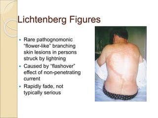 Lichtenberg Figures
 Rare pathognomonic
“flower-like” branching
skin lesions in persons
struck by lightning
 Caused by “flashover”
effect of non-penetrating
current
 Rapidly fade, not
typically serious
 