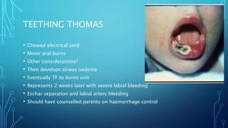 TEETHING THOMAS
• Chewed electrical cord
• Minor oral burns
• Other considerations?
• Then develops airway oedema
• Eventually TF to burns unit
• Represents 2 weeks later with severe labial bleeding
• Eschar separation and labial artery bleeding
• Should have counselled parents on haemorrhage control
 