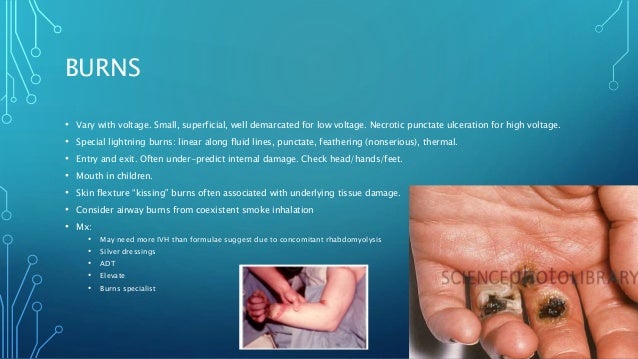 Electrical burn injury