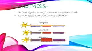 NEUROTMESIS:-
• the term applied to complete section of the nerve trunk
• occur on severe contusion, stretch, laceration
 