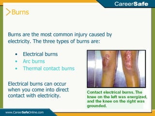Burns www.Career Safe Online.com Burns are the most common injury caused by electricity. The three types of burns are: Electrical burns Arc burns Thermal contact burns Electrical burns can occur when you come into direct contact with electricity. 