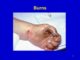 9
Burns
 