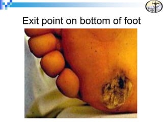 Exit point on bottom of foot
 