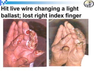 Hit live wire changing a light
ballast; lost right index finger
 