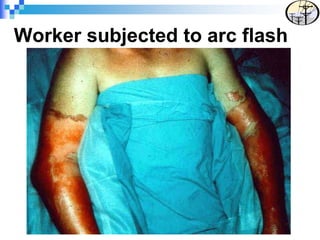 Worker subjected to arc flash
 