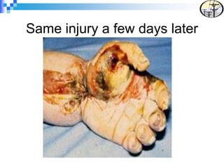 Same injury a few days later
 