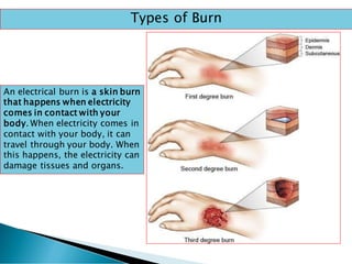 Electric Burn Example ELECTRICAL SAFETY AWARENES.pdf