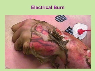 Electrical Burn
10TANGEDCO
 