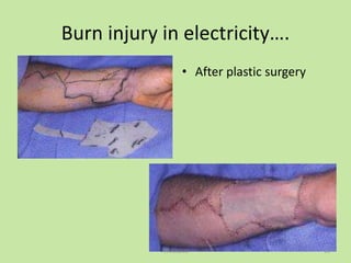 Burn injury in electricity….
• After plastic surgery
15TANGEDCO
 