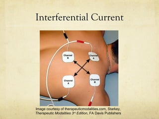 Interferential Current
Image courtesy of therapeuticmodalities.com, Starkey,
Therapeutic Modalities 3rd
Edition, FA Davis Publishers
 