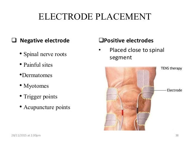 Electrode Placement For Electrical Stimulation Chart