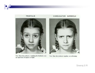Sreeraj S R
Motor Points of Facial Nerve
 