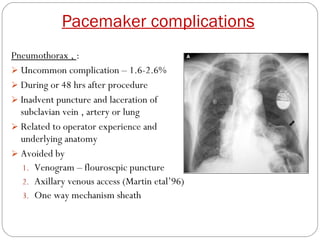 Pacemaker complications
Pneumothorax , :
 Uncommon complication – 1.6-2.6%
 During or 48 hrs after procedure
 Inadvent puncture and laceration of
  subclavian vein , artery or lung
 Related to operator experience and
  underlying anatomy
 Avoided by
   1. Venogram – flouroscpic puncture
   2. Axillary venous access (Martin etal’96)
   3. One way mechanism sheath
 
