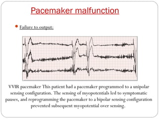 Pacemaker malfunction
     Failure to output:




 VVIR pacemaker This patient had a pacemaker programmed to a unipolar
  sensing configuration. The sensing of myopotentials led to symptomatic
pauses, and reprogramming the pacemaker to a bipolar sensing configuration
             prevented subsequent myopotential over sensing.
 