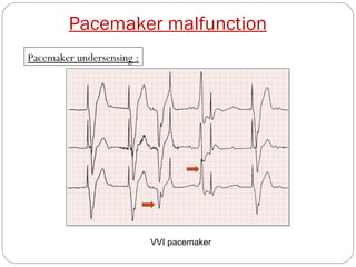 Pacemaker malfunction
Pacemaker undersensing :




                           VVI pacemaker
 