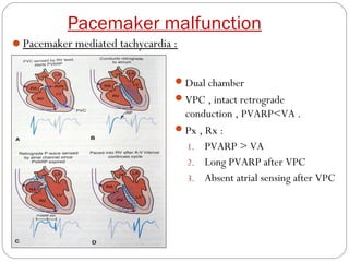 Pacemaker malfunction
Pacemaker mediated tachycardia :


                                 Dual chamber
                                 VPC , intact retrograde
                                  conduction , PVARP<VA .
                                 Px , Rx :
                                  1. PVARP > VA
                                  2. Long PVARP after VPC
                                  3. Absent atrial sensing after VPC
 