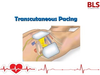Transcutaneous PacingTranscutaneous Pacing
 