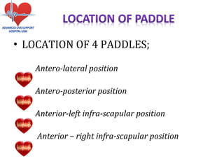 • LOCATION OF 4 PADDLES;
Antero-lateral position
Antero-posterior position
Anterior-left infra-scapular position
Anterior – right infra-scapular position
 